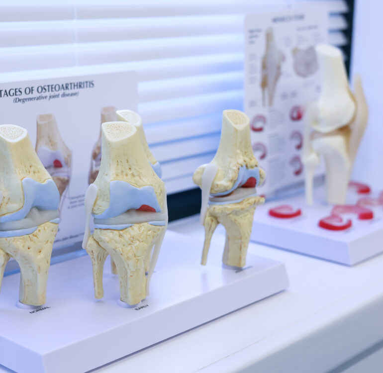 Modelos anatómicos do joelho utilizados na explicação clínica de patologias